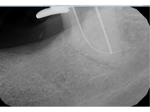 Медиально-щёчный канал Медиально-щёчный канал
