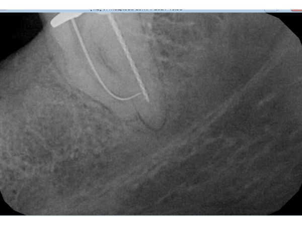 Медиально-язычный канал Медиально-язычный канал