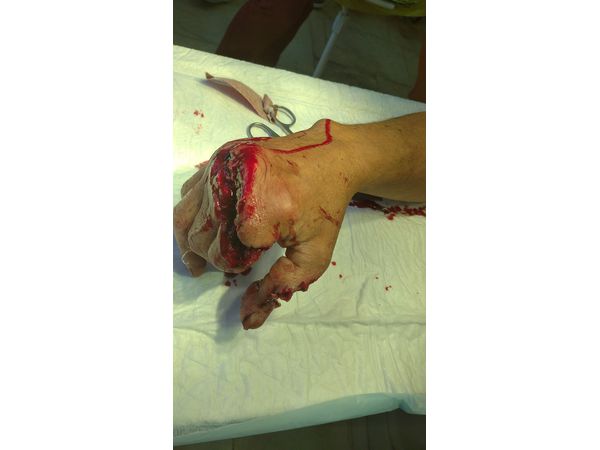 Рваная рана правой кисти