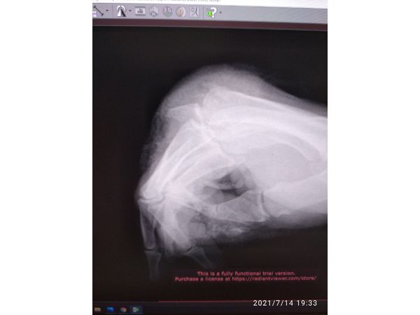 Рентгенограмма правой кисти до операции