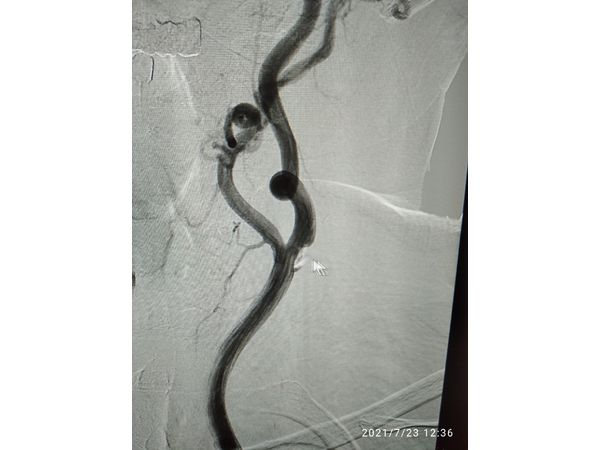 Атеросклеротическая бляшка на фоне патологической извитости сонной артерии