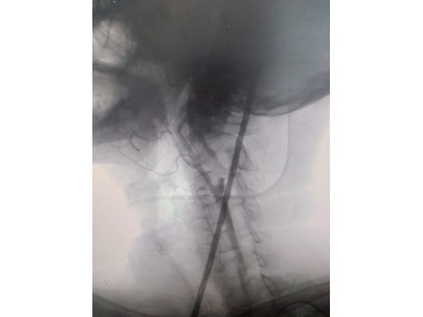 Ангиография сонной артерии слева: критический стеноз внутренней сонной артерии