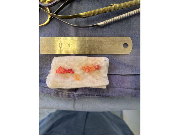 Атеросклеротическая бляшка, удалённая из из просвета сосуда