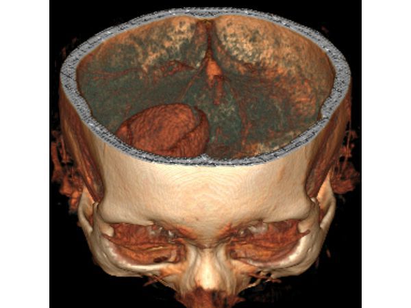 3D-реконструкция объёмного образования правой лобной доли головного мозга, выполненная на основании сканов КТ с контрастным усилением 3D-реконструкция объёмного образования правой лобной доли головного мозга, выполненная на основании сканов КТ с контрастным усилением