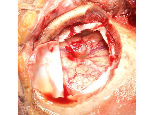 Интраоперационная фотография, выполненная после аспирации гнойного содержимого из полости абсцесса и промывания полости антисептическими растворами Интраоперационная фотография, выполненная после аспирации гнойного содержимого из полости абсцесса и промывания полости антисептическими растворами