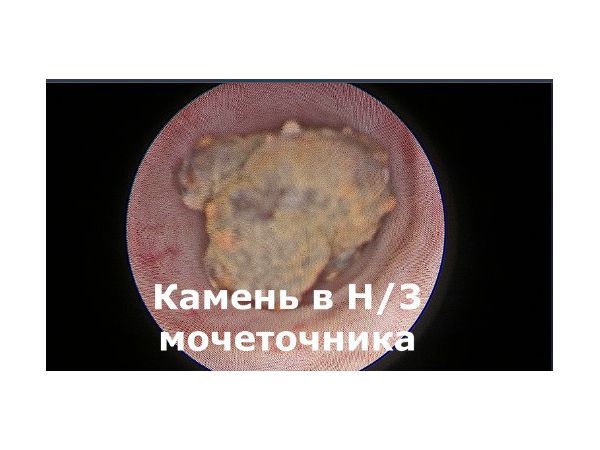 Литотрипсия камней в мочеточнике как происходит