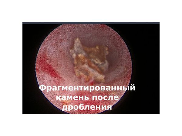Литотрипсия камней в мочеточнике как происходит