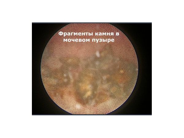Литотрипсия камней в мочеточнике как происходит