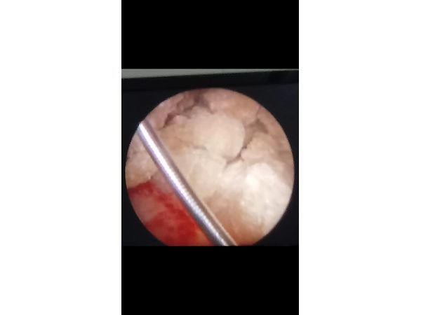 Этап операции: фрагментированный камень в лоханке левой почки