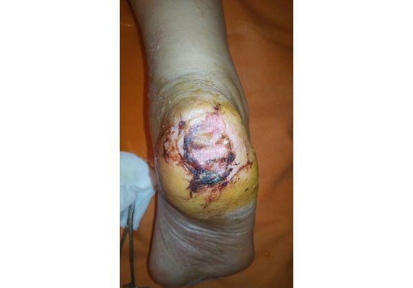 Вид стопы через три дня после аутодерматопластики
