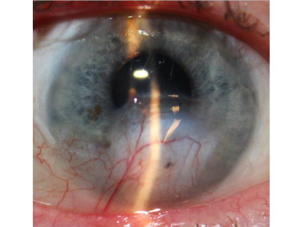 Состояние правого глаза спустя семь месяцев после лечебного покрытия перфорации роговицы аутоконъюнктивой с блефарорафией и два месяцев после удаления катаракты с имплантацией линзы
