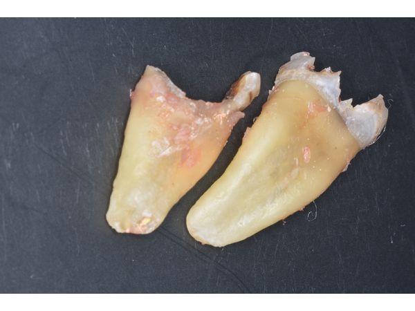 Удалённые корни зуба 4.6