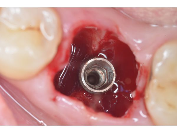 Установлен имплантат 