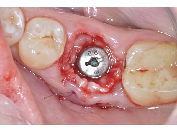 На имплантат установлен формирователь десны, произведено увеличение мягких тканей