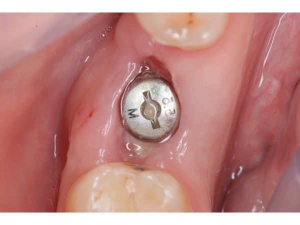 Через две недели произошло полное заживление