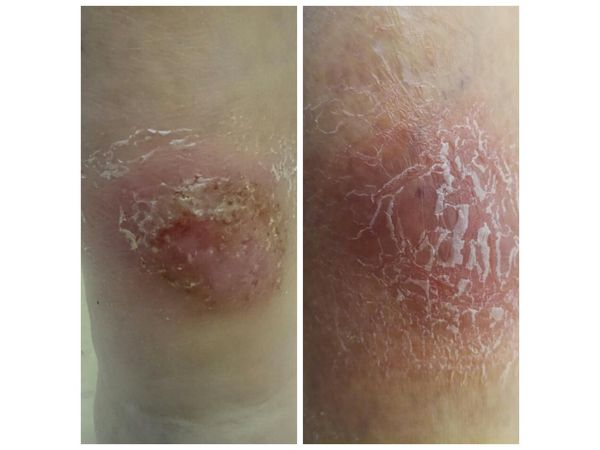 Правая голень на первичном и на повторном осмотре (через 10 дней) Правая голень на первичном и на повторном осмотре (через 10 дней)