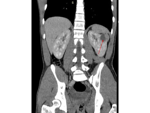 Кт картина образования правой почки