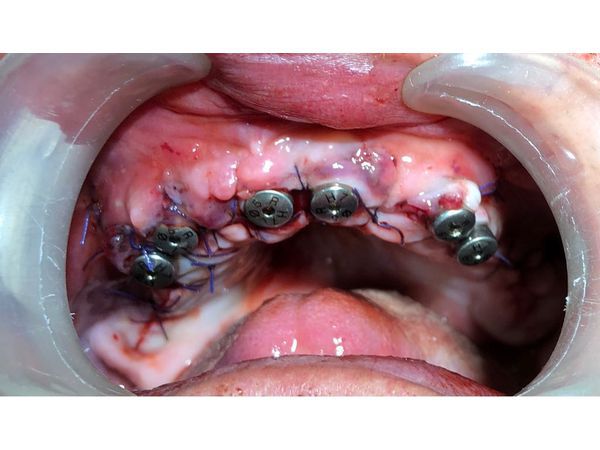 Установка формирователей десны на верхней челюсти (через 7 дней после удаления зубов)