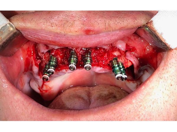 Установка имплантатов на верхней челюсти (через 7 дней после удаления зубов)