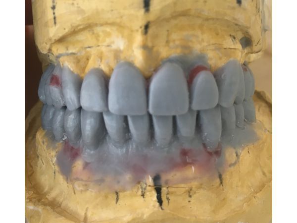 Диагностическое моделирование (через 4 дня после удаления зубов): для принятия решения о съемном или несъемном протезировании