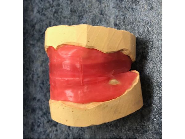 Изготовление прикусного шаблона (через 4 дня после удаления зубов)