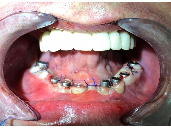 Установка формирователей десны на нижнюю челюсть (через 11 дней после удаления зубов)