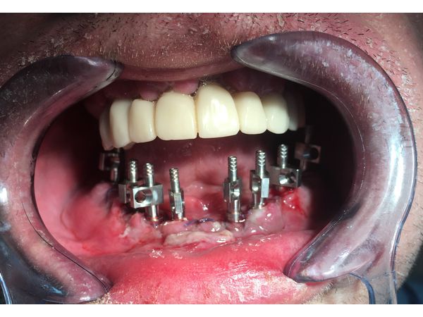 Установка трансферов на имплантаты нижней челюсти (через 12 дней после удаления зубов)
