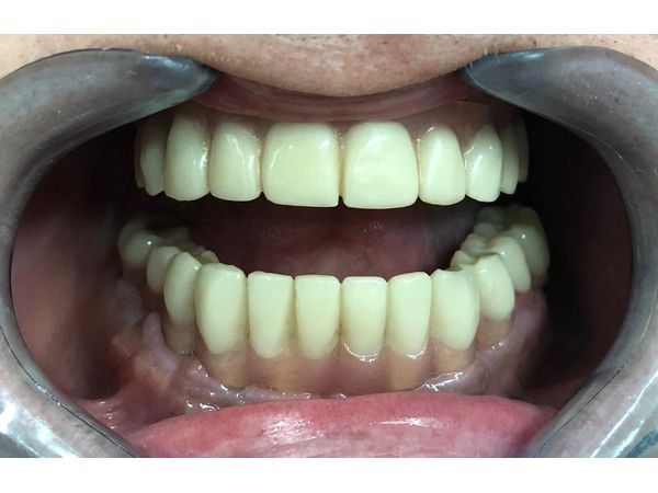 Итог временной реставрации на имплантатах (через 14 дней после удаления зубов)