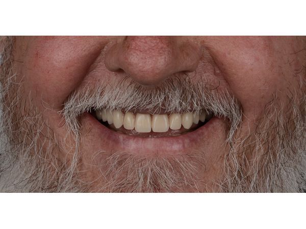 Фото пациента после реабилитации Фото пациента после реабилитации