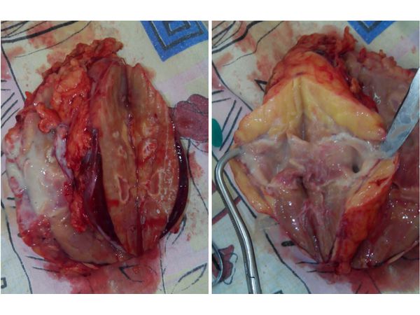 Удалённая левая почка: видны полости, заполненные гнойным содержимым и газом