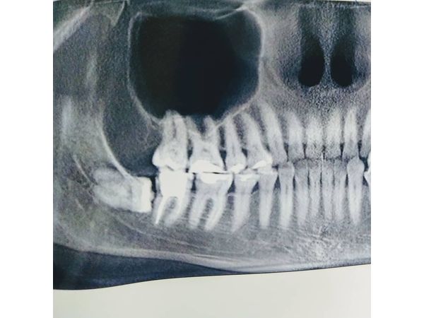 Ретенированный зуб на диагностическом снимке (ОПТГ)